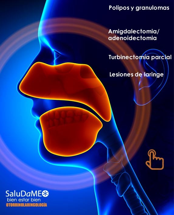Laser Diodo Quirurgico OTORRINOLARINGOLOGIA