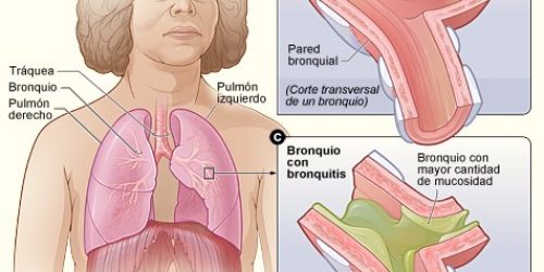 Consejos para una bronquitis